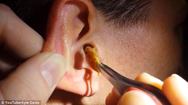 How do you remove ear wax blockage?